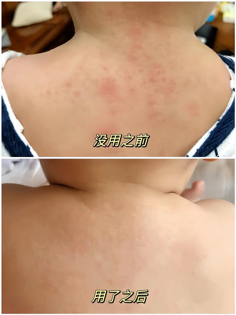 儿童去痱子止痒最有效的方法-儿童去痱子止痒最有效的方法图片
