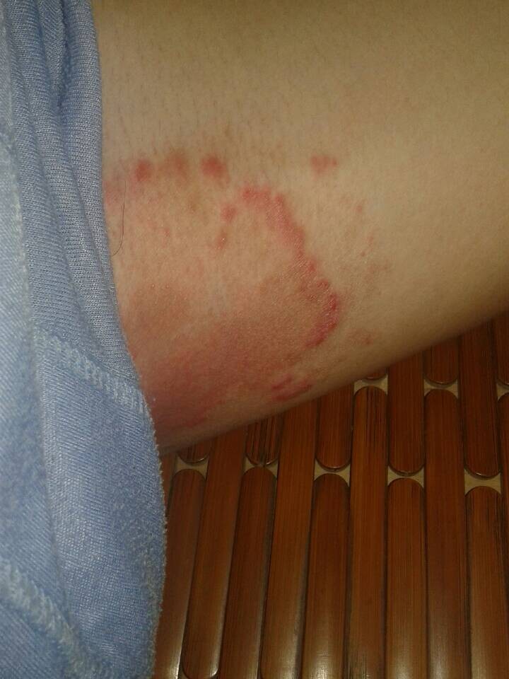 大腿根部很痒还有包,大腿根部很痒还有包块怎么办
